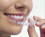 mascherine di  contenzione ortodontica roma