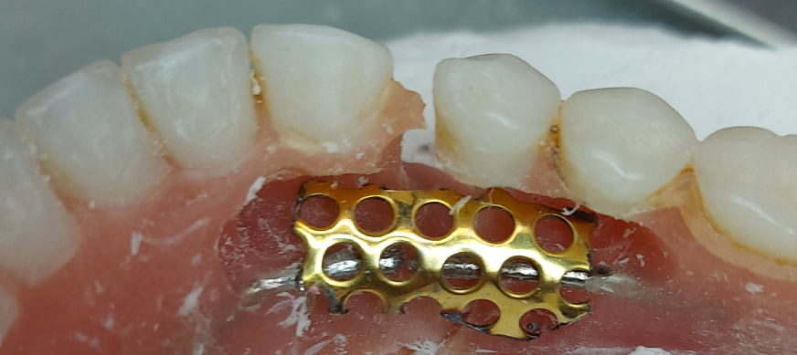 riparazione protesi dentale laboratorio odontotecnico roma
