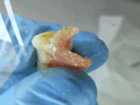 riparazione protesi e dentiere roma